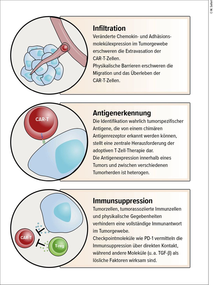 CARTZellTherapie bei soliden Tumoren Onkologie Universimed